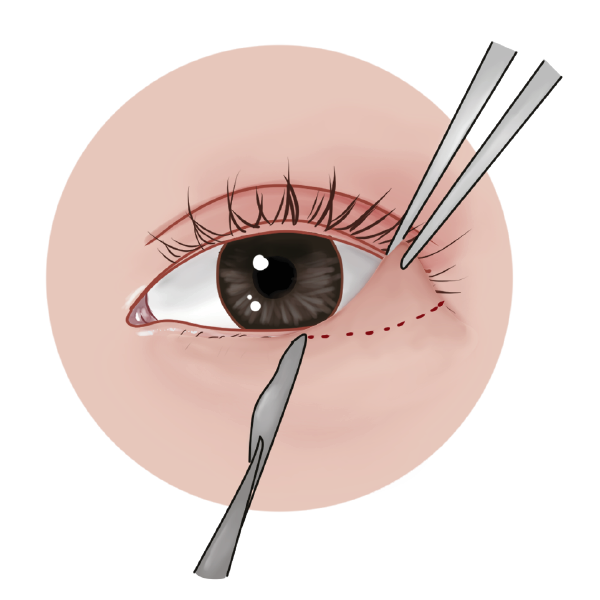 dokter-akan-membuka-sayatan-di-kulit-kelopak-mata-bagian-atas