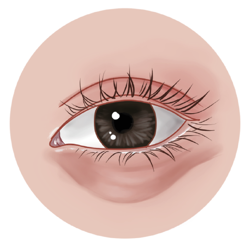 menanda-kelopak-mata-dengan-spidol-medis-untuk-memastikan-sterilisasi-area-sebelum-membuat-sayatan